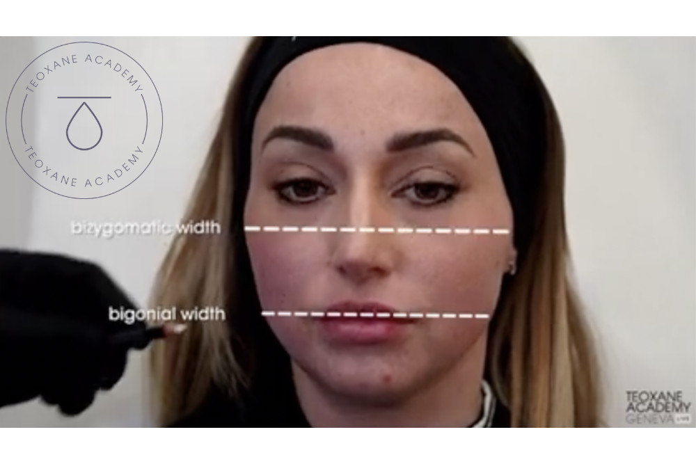 teoxane anatomy patient assessment