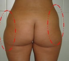 cellulite1