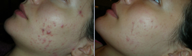 trattamento-cicatrici-acne-caso1_Giuseppe-Sito