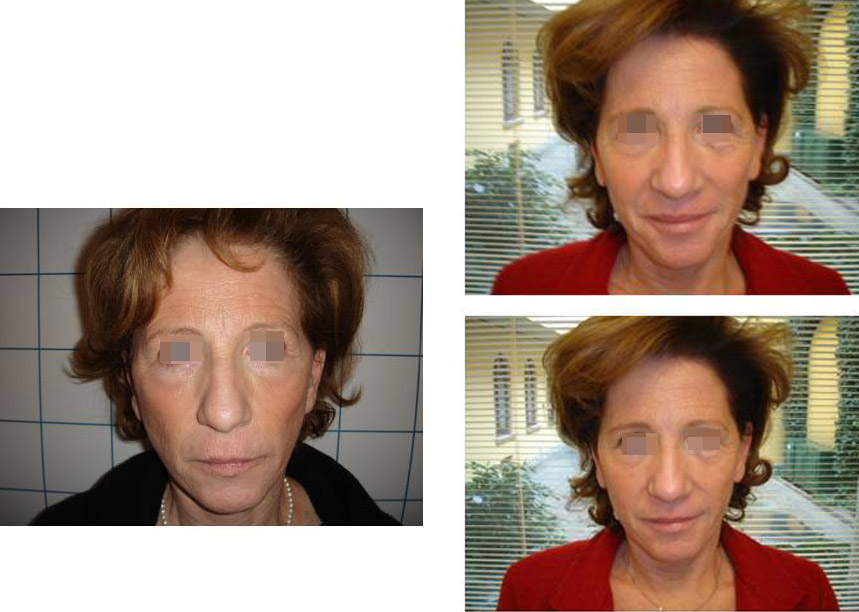 prof-Giuseppe-Sito-medico-estetico-filler-viso-1_p